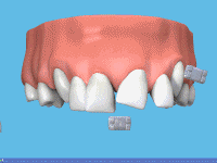 brekety_metall_2